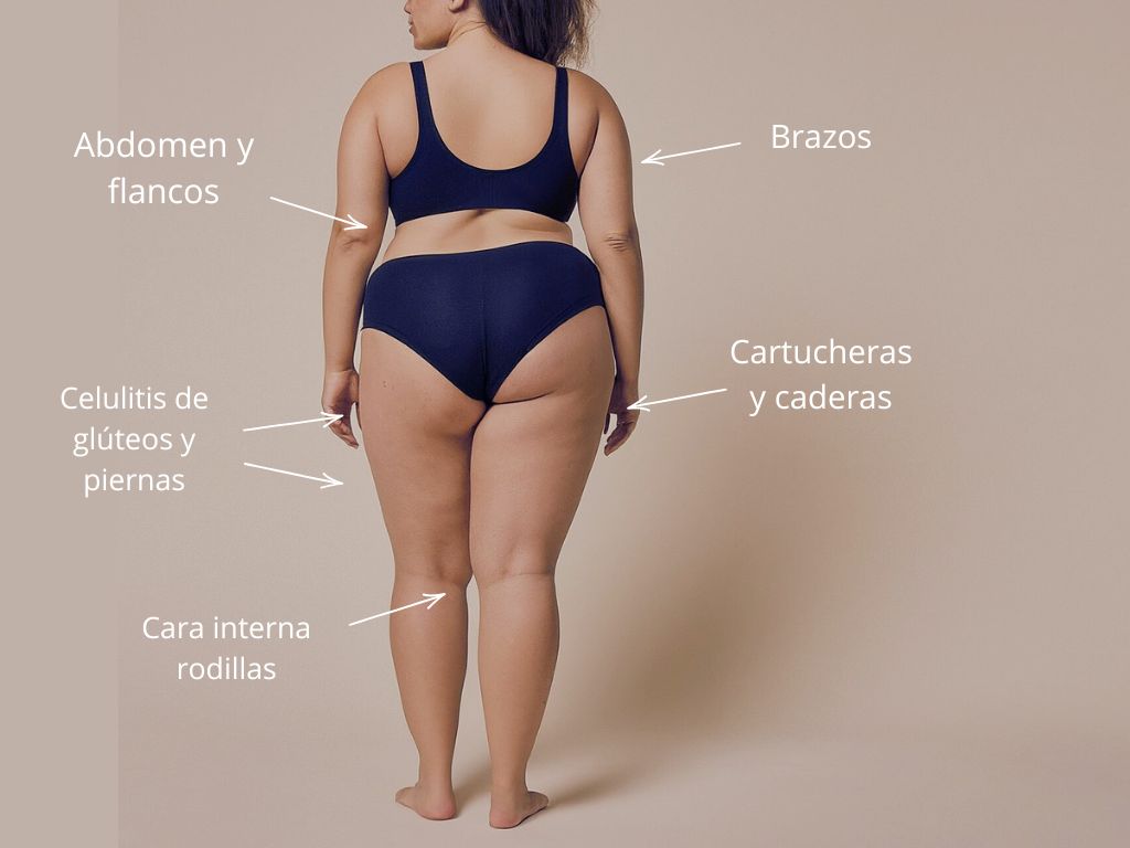 Zonas de aplicacion tratamiento de carboxiterapia