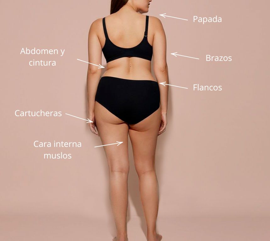 Cuerpo de mujer donde se señalan las zonas de aplicacion del tratamiento de Criolipolisis CoolSculpting en Clínica Aroma en Benalmádena